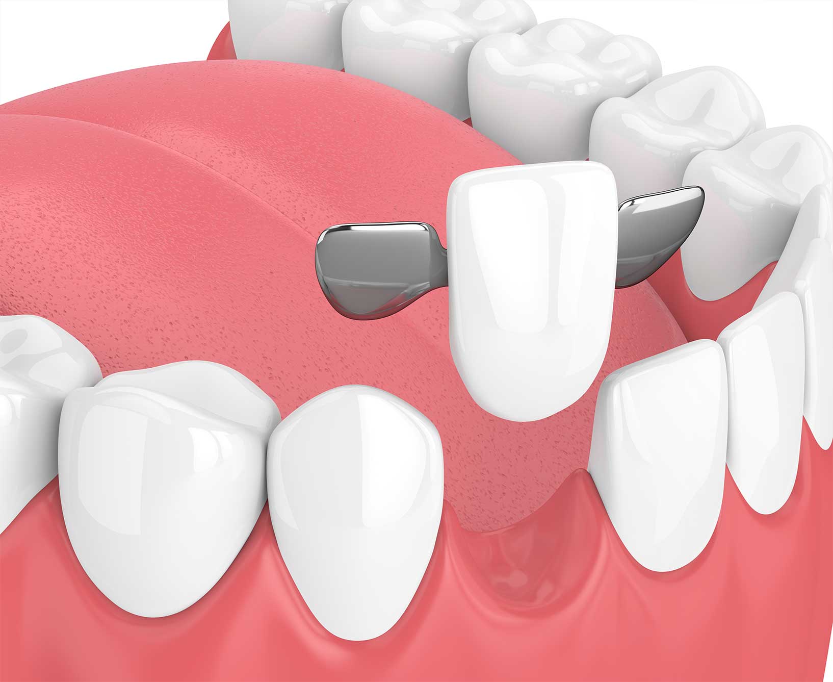  dental bridge front teeth nhs